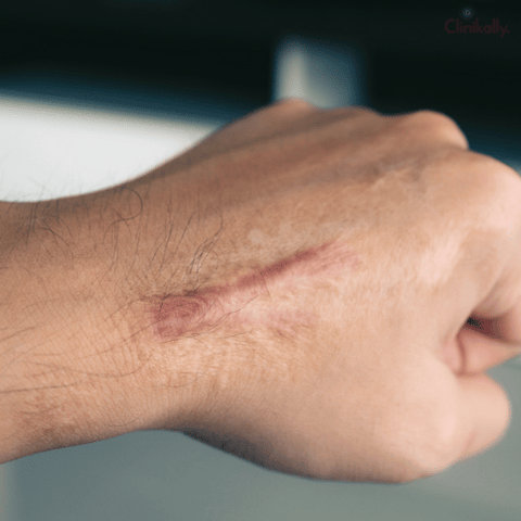 hypertrophic scar