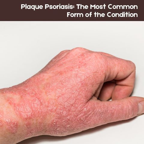 Plaque Psoriasis: The Most Common Form of the Condition