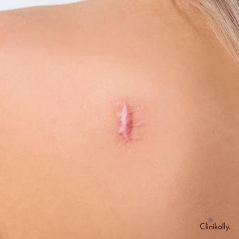 hypertrophic scar