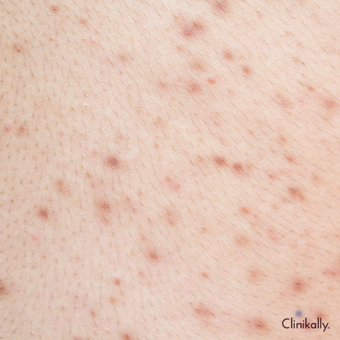Chest Acne Causes, Treatments, and Prevention