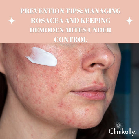 Prevention Tips: Managing Rosacea and Keeping Demodex Mites Under Control