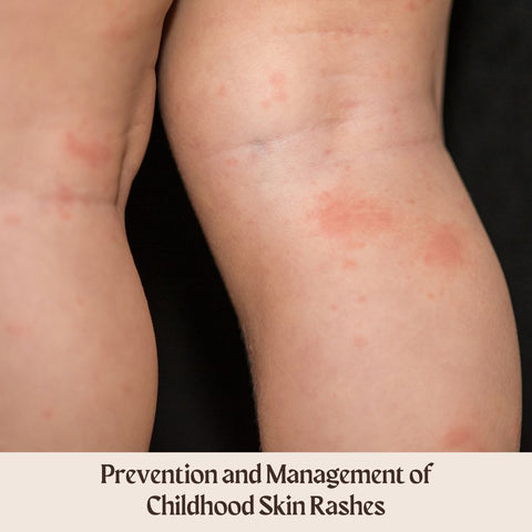 Prevention and Management of Childhood Skin Rashes