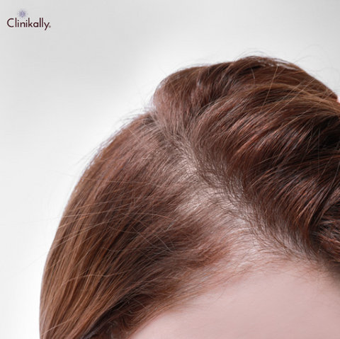 Is Minoxidil (Rogaine) Safe for Women? Doctor's Guide