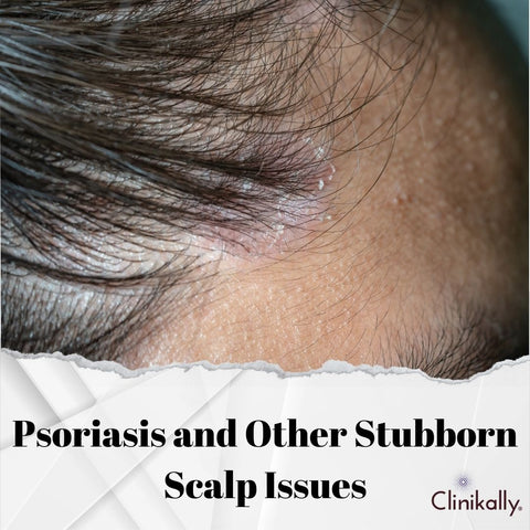 Psoriasis and Other Stubborn Scalp Issues