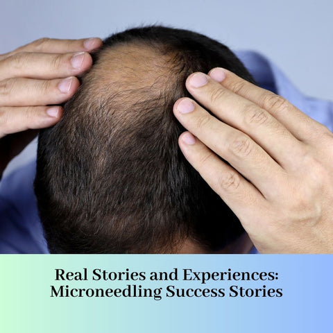 Real Stories and Experiences: Microneedling Success Stories