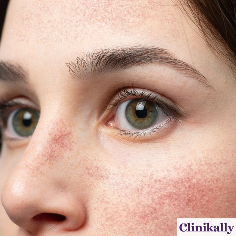 Women with close-up of couperose skin