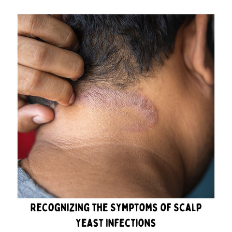Recognizing the Symptoms of Scalp Yeast Infections