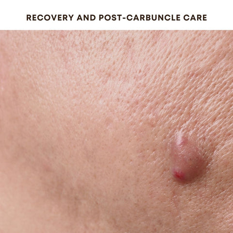 Recovery and Post-Carbuncle Care