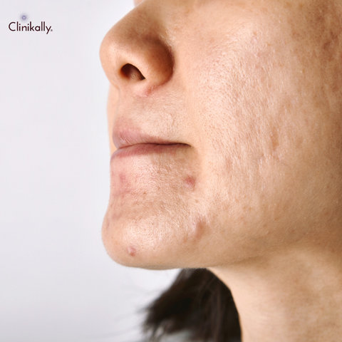 body acne treatments