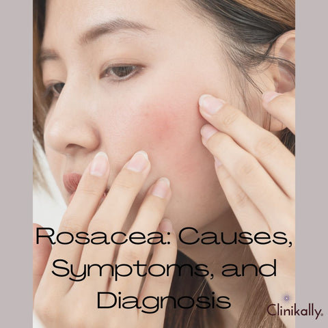 Rosacea: Causes, Symptoms, and Diagnosis