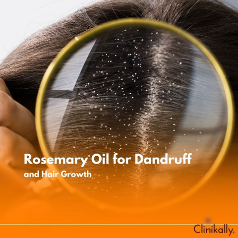 Rosemary Oil for Dandruff and Hair Growth
