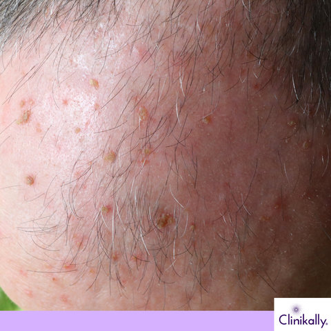 Actinic Keratosis patch on scalp