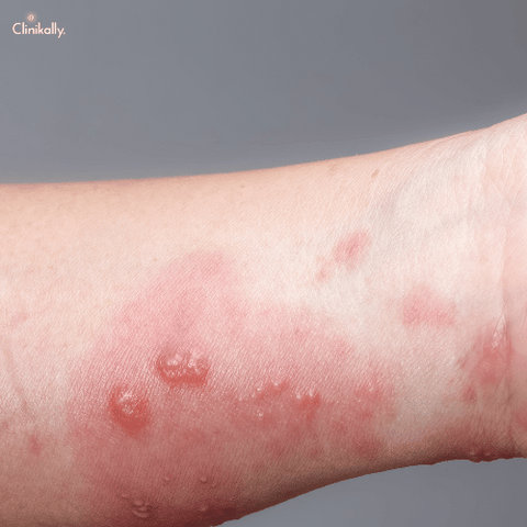 scabies rash 