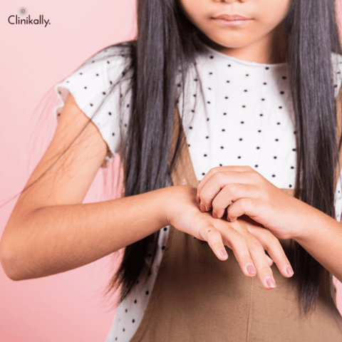 scabies rash 