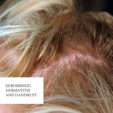 Seborrheic Dermatitis and Dandruff