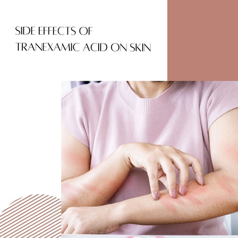 Side Effects of Tranexamic Acid on Skin