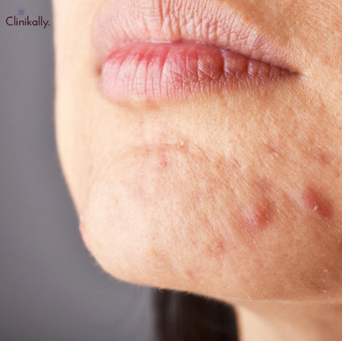 Rosacea
