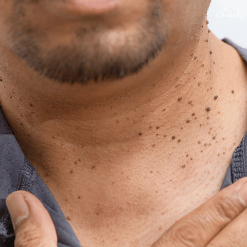 wart removal