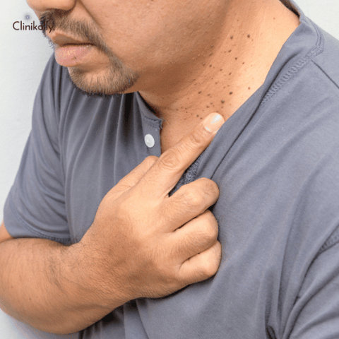 Wart Removal with Salicylic Acid