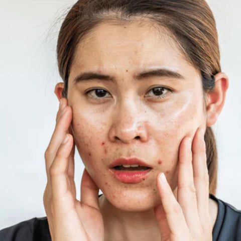 Squalene for Acne Prone Skin