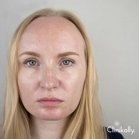 Squalene for Oily Skin