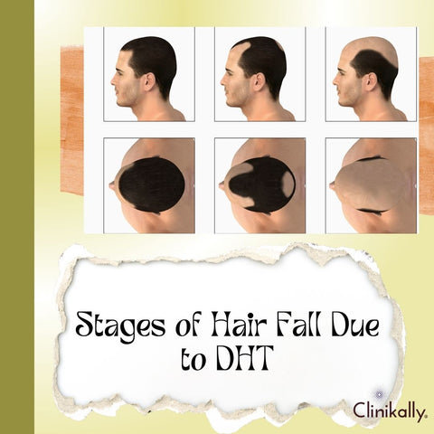 Stages of Hair Fall Due to DHT
