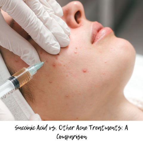 Succinic Acid vs. Other Acne Treatments: A Comparison