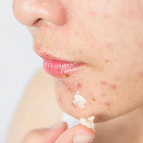 Sulfur and Acne: A Match Made in Skin Heaven