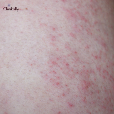 Heat Rash in Adults Causes, Symptoms, and Effective Treatments