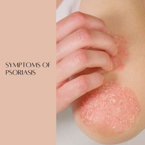 Symptoms of Psoriasis