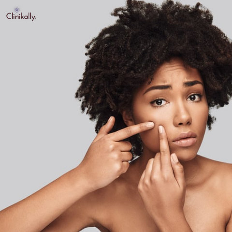 Hormonal Acne