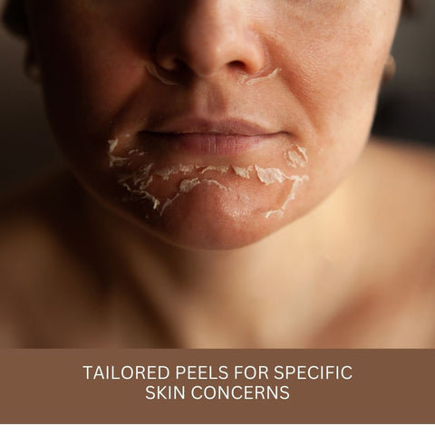 Tailored Peels for Specific Skin Concerns