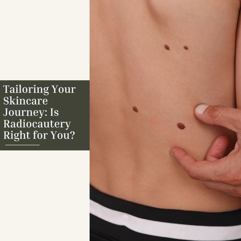 Tailoring Your Skincare Journey: Is Radiocautery Right for You?