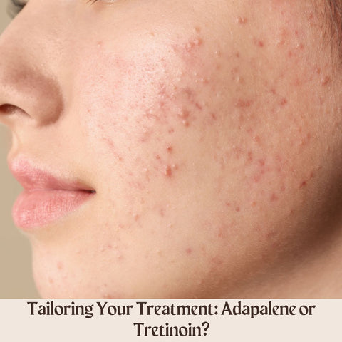 Tailoring Your Treatment: Adapalene or Tretinoin?