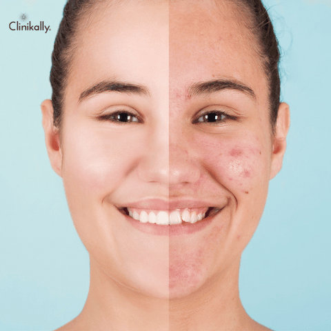Teenage acne vs Adult acne
