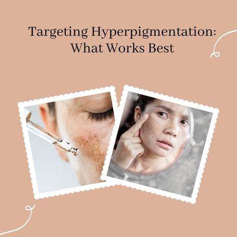 Targeting Hyperpigmentation: What Works Best