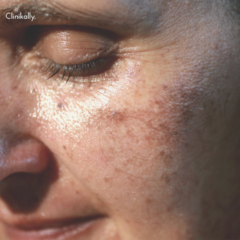 glycolic acid acne treatment 