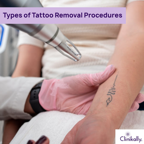 Type of Tattoo Removal Procedures