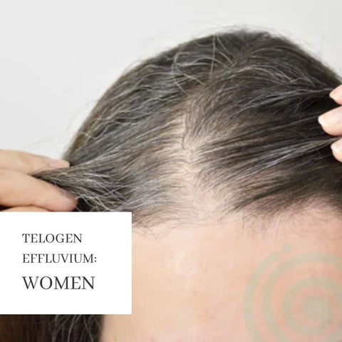 Telogen Effluvium: Women