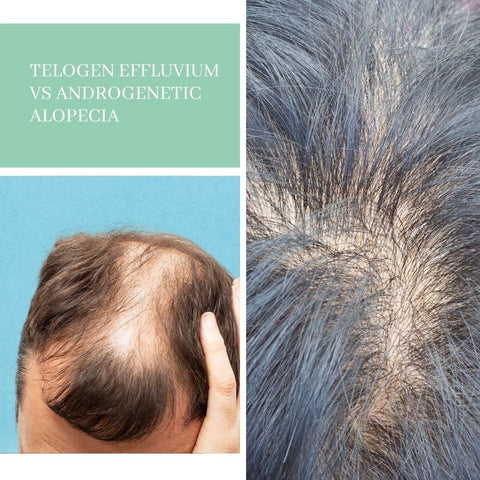 Telogen Effluvium vs Androgenetic Alopecia