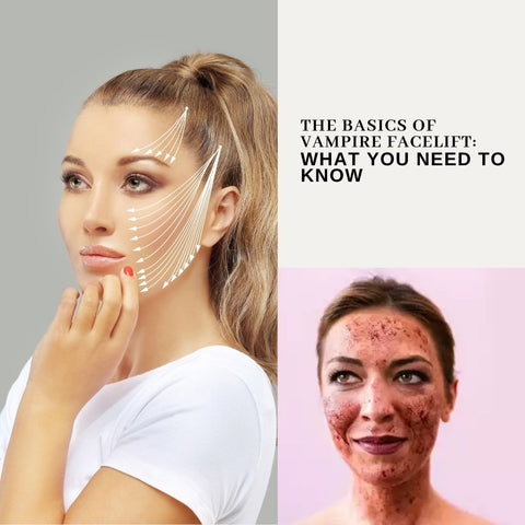 The Basics of Vampire Facelift: What You Need to Know