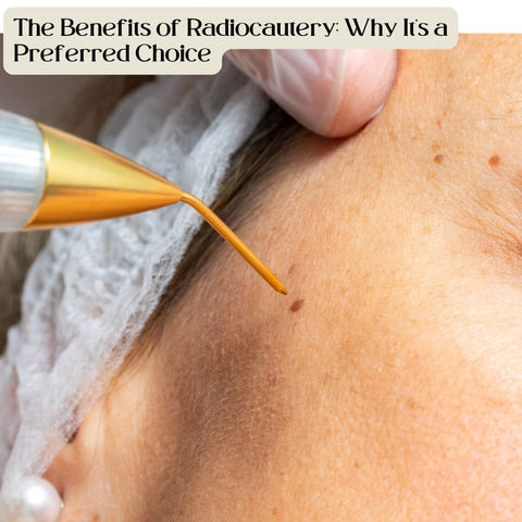 The Benefits of Radiocautery: Why It’s a Preferred Choice