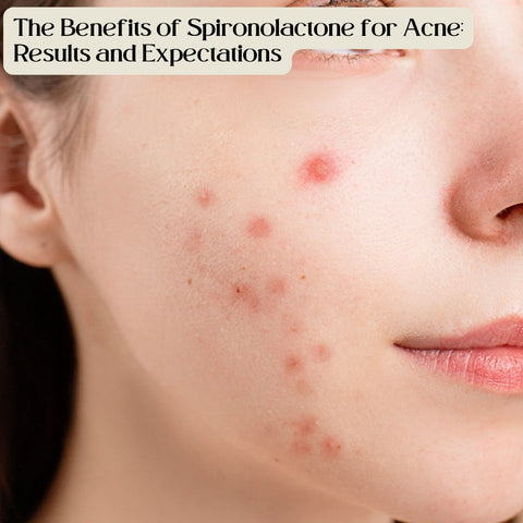 The Benefits of Spironolactone for Acne: Results and Expectations