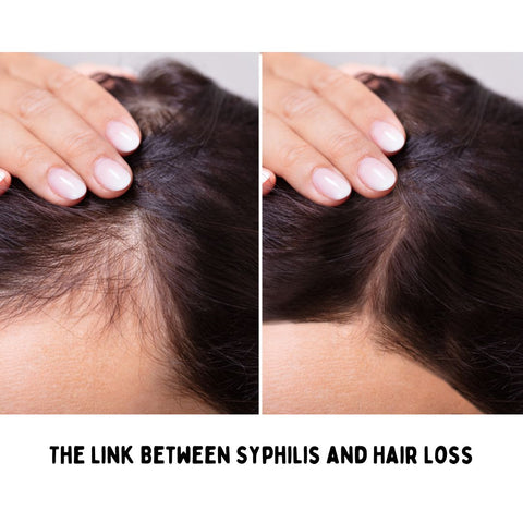 The Link Between Syphilis and Hair Loss