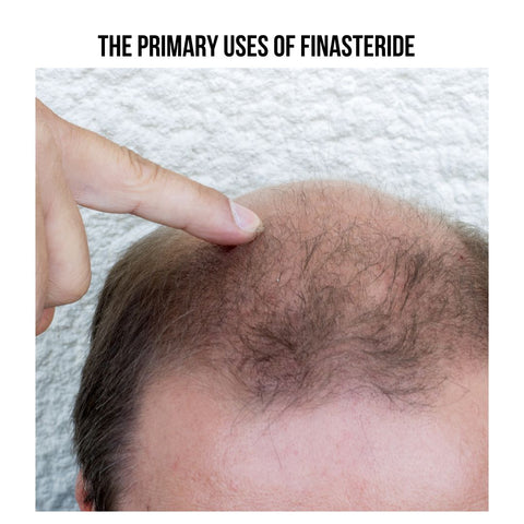 The Primary Uses of Finasteride
