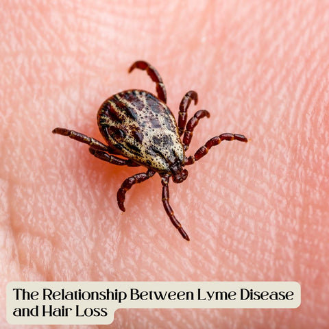 The Relationship Between Lyme Disease and Hair Loss