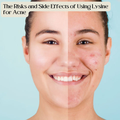 The Risks and Side Effects of Using Lysine for Acne