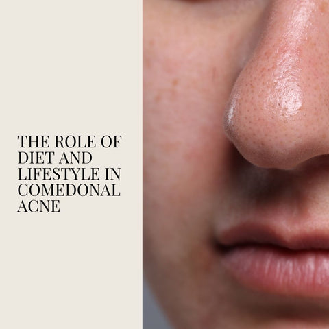 The Role of Diet and Lifestyle in Comedonal Acne