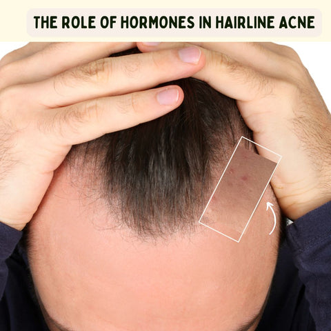 The Role of Hormones in Hairline Acne