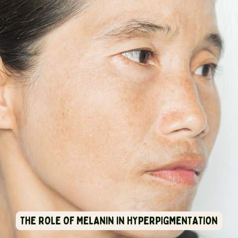 The Role of Melanin in Hyperpigmentation